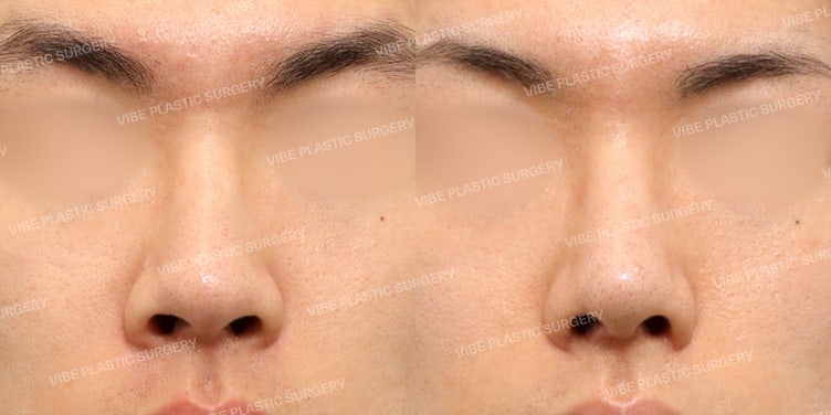 تحقيق مظهر أنف ذكوري طبيعي ورائع من خلال تجميل الأنف بدون غرسات وتصحيح الأنف العريض!