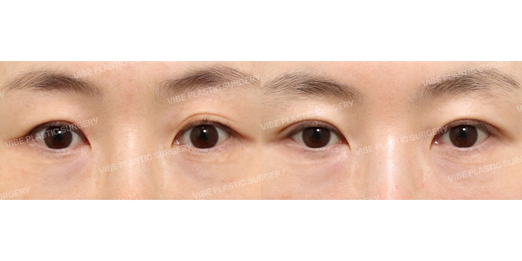 自然的中老年眼部整形(上睑成形术)