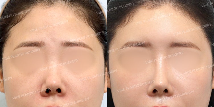 Dimensi Wajah Mewah yang Sempurna dengan Koreksi Hidung Pendek dan Volume Dahi!