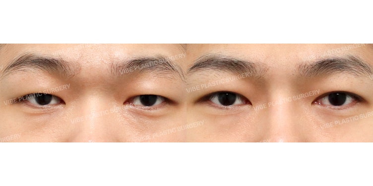 남자 무쌍 눈매교정도 바이브 성형외과에서 !