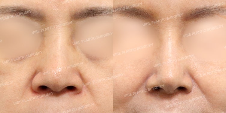 Keputusan Besar Setelah 30 Tahun! Kasus Revisi Operasi Hidung yang Sangat Memuaskan :D