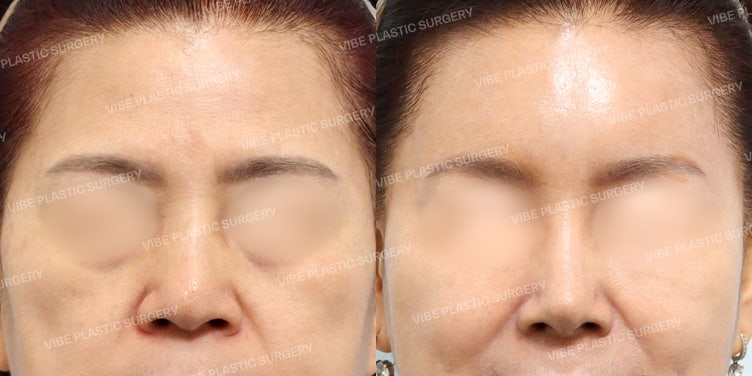 Rejuvenating the Line from Forehead to Nose Bridge! A Highly Satisfying Middle-Aged Revision Rhinoplasty Case :D