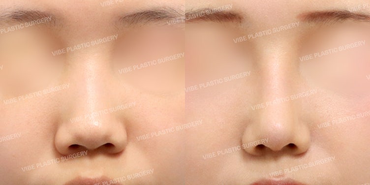 خط الأنف المميز من عيادة فايب للتجميل 💎: تحول وجه أنيق من خلال تصحيح الأنف العريض