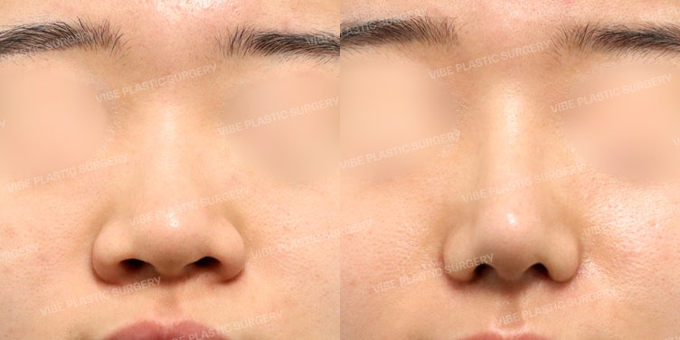 قصة عملية تجميل الأنف لامرأة في العشرينيات كانت تعاني من ضغوط الأنف العريض 💎 - عيادة فايب للتجميل