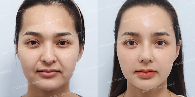 ๐ธ Youth in Her 20s, Completing a Lovely Face! - Dr. Yoo Young-moon, VIBE Plastic Surgery