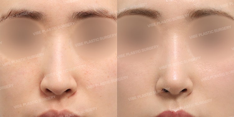 Hiko Thread Removal and No-Implant Rhinoplasty Case Study!