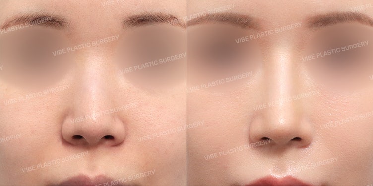 ✨ تجميل الأنف بخط مستقيم منحني (Straight-Semi-Basal) أنثوي وأنيق - د. يو يونغ-مون من عيادة فايب للتجميل