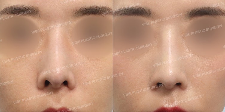 👃 تصحيح فتحات الأنف على شكل »أنف التنين« — عملية خفض حافة الأنف بواسطة الدكتور يو يونغ-مون، عيادة فايب للتجميل