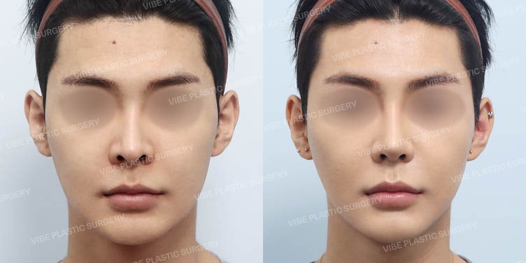 د. يو يونغ-مون من عيادة فايب للتجميل: 👃 تقليل ظهور فتحات الأنف! خط الأنف المستقيم هو الأنسب للرجال!
