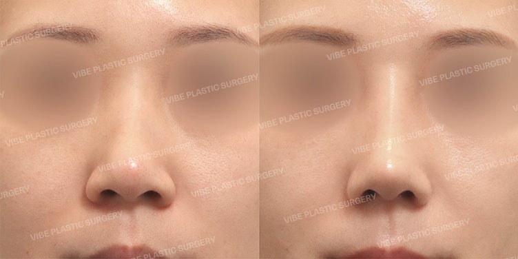ملخص مميزات عملية تجميل الأنف باستخدام غضروف الضلع الذاتي (لماذا يعد تصحيح الأنف العريض والزاوية الأنفية الشفوية ضروريًا) - د. يو يونغ مون، عيادة فايب للتجميل
