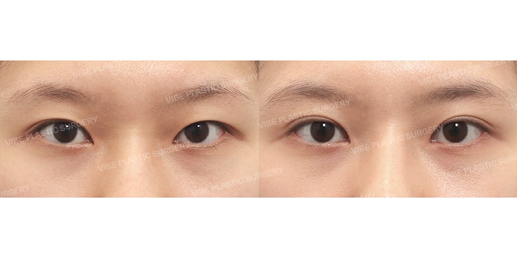 Summary of Natural Adhesion Double Eyelid Surgery Benefits (Why It's Ideal for First-Time Eye Surgery) - Dr. Yoo Young-moon, VIBE Plastic Surgery