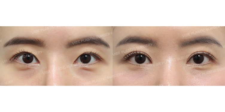 Incisional Double Eyelid Revision Case (Restoring Faded Lines from 10 Years Ago) by Dr. Young-moon Yoo, VIBE Plastic Surgery