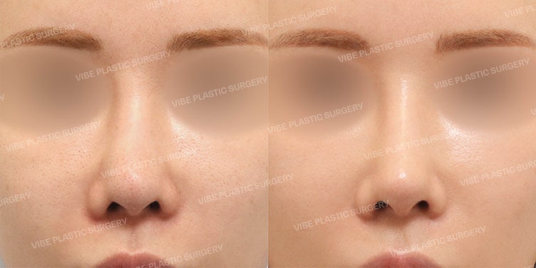عملية إعادة تجميل الأنف، هل يجب إزالة كل شيء؟ | حالة إعادة تجميل الأنف مع الحفاظ على دعامة الحاجز الأنفي بقلم الدكتور يو يونغ-مون، مدير عيادة فايب للتجميل في محطة غانغنام