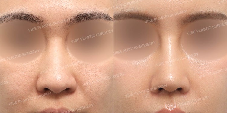 Primary Rhinoplasty with Autologous Rib Cartilage (Bulbous Nose, Droopy Tip, Nasolabial Angle Correction) / Why Choose Rib Cartilage for the First Surgery? by Dr. Young-moon Yoo, VIBE Plastic Surgery