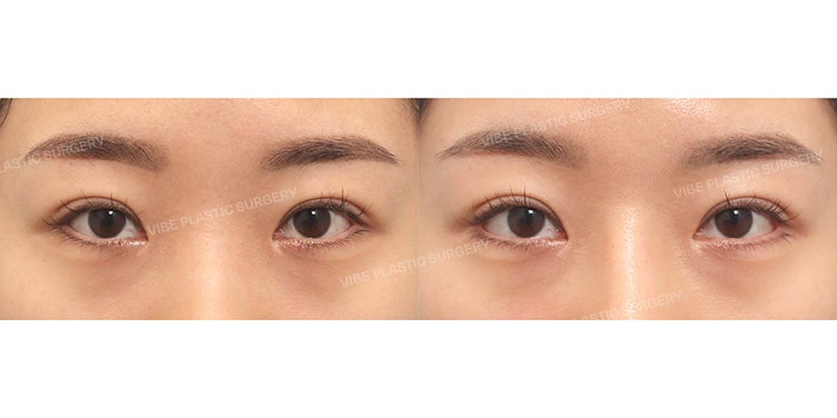 Improving a Stuffy Eye Look with Lateral and Lower Canthoplasty by Dr. Young-moon Yoo of VIBE Plastic Surgery