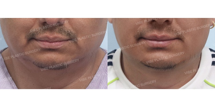 تجربة تصحيح الذقن المزدوجة وخط الفك | لماذا جاءت هذه العميلة من كندا إلى كوريا؟ بقلم الدكتور يو يونغ-مون، مدير عيادة فايب للتجميل