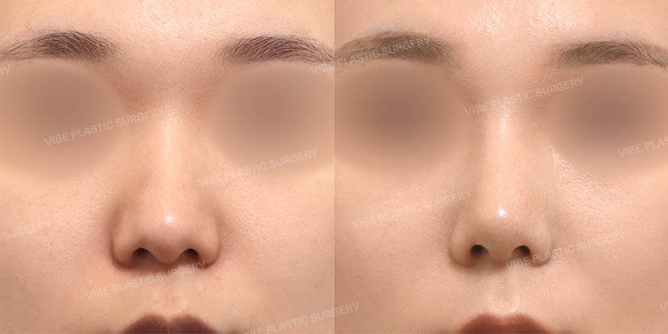 Correcting Hump, Bulbous Tip, and Droopy Nose All at Once! Rhinoplasty at Vibe Plastic Surgery (Gangnam/Sinnonhyeon)