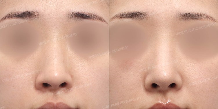 매부리코·처진코끝·복코 한번에 교정｜비중격 연골 코성형으로 자연스럽게 달라진 20대 여성 코수술 후기 by 신논현역 바이브 성형외과