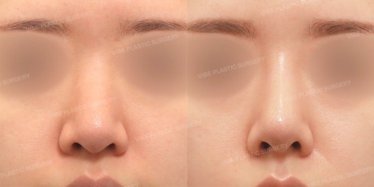 피부 두꺼운 복코성형은 왜 늑연골이 필요할까?|자가늑연골 코성형으로 완성한 자려한 직반코라인 by 강남역 코성형외과 유영문 원장