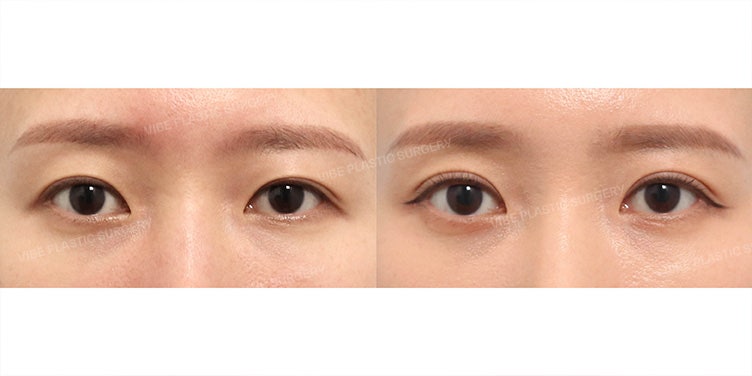 Worried About Sleepy Eyes and Asymmetry? - Dr. Young-moon Yoo, VIBE Plastic Surgery (Sinnonhyeon Station)
