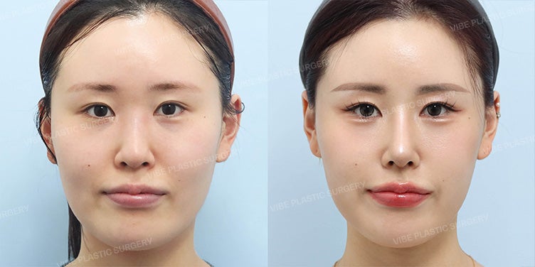 자가 늑연골을 이용한 기능코 수술과 복코 교정 ! by 신논현역 바이브 성형외과 유영문 원장