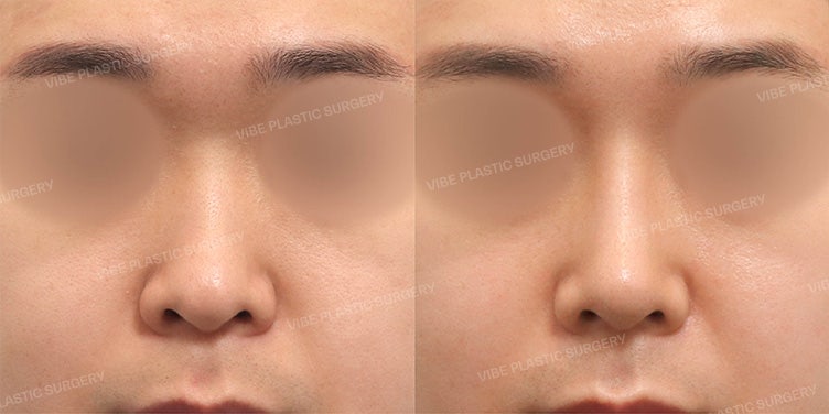 حالة تجميل أنف طبيعية للذكور تحسن الأنف الغليظ والجسر المنخفض معاً - عيادة فايب التجميلية