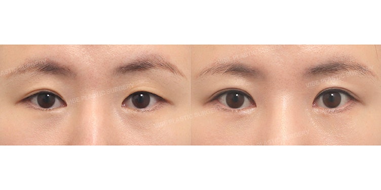 10年前的埋线双眼皮松脱了怎么办？切开双眼皮修复手术案例