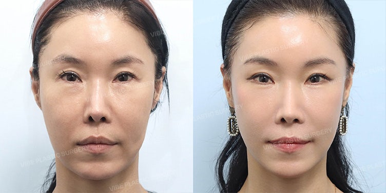 ความเห็นก่อนและหลังการผ่าตัดยกหน้าในวัย 50 ปี | ผลลัพธ์การยก SMAS และการเปลี่ยนแปลงที่เป็นธรรมชาติ