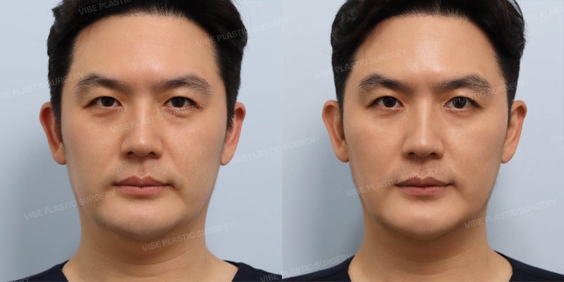 남자 얼굴지방흡입 직접 후기 - 리포사운드, 이중턱 실리프팅, 울쎄라 병행