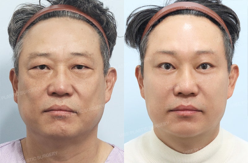 자연스럽게 젊어진 50대 남성 눈성형 - 신논현 바이브성형외과 유영문 원장