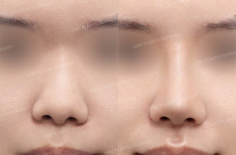 [جراحة تجميل الأنف للرجال] مراجعة حقيقية لرجل في العشرينات من عمره قام بحل مشكلة انخفاض جسر الأنف والأنف المنتفخ، وحتى مشكلة انخفاض منتصف الوجه، بواسطة الدكتور يو يونغ مون من عيادة فايبر للتجميل في محطة سيننون هيون