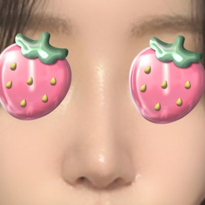 짧아진 코, 다시 길게 만들 수 있을까? (자가늑연골 코성형) by 신논현역 바이브 성형외과 유영문 원장 사진 10