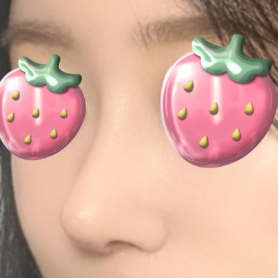 짧아진 코, 다시 길게 만들 수 있을까? (자가늑연골 코성형) by 신논현역 바이브 성형외과 유영문 원장 사진 12