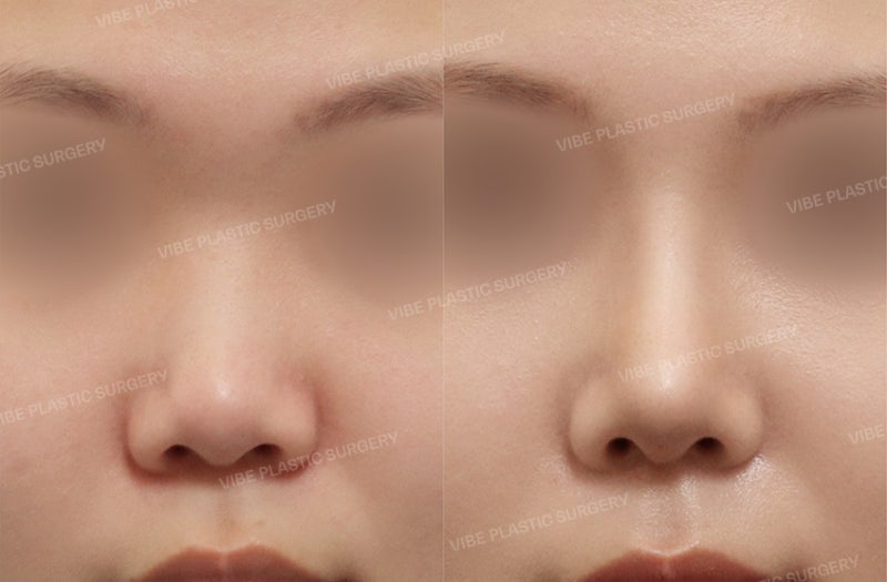 فايب لجراحة التجميل