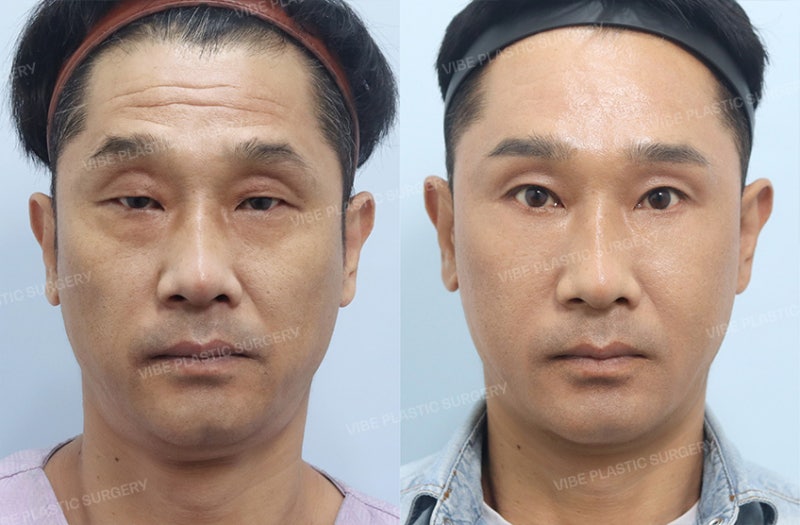 눈 뜨는 힘이 약하고 유독 나이가 들어보인다면? 50대 남자 눈성형 케이스 by 신논현역 바이브 성형외과 유영문 원장