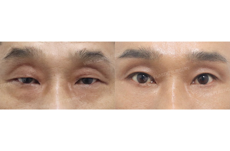 ศัลยกรรมตาสำหรับผู้ชายวัยกลางคน - การเปลี่ยนแปลงที่ชัดเจนแต่ดูเป็นธรรมชาติ โดย นพ. ยู ย็องมุน โรงพยาบาลศัลยกรรม VIBE สถานีชินนนฮยอน