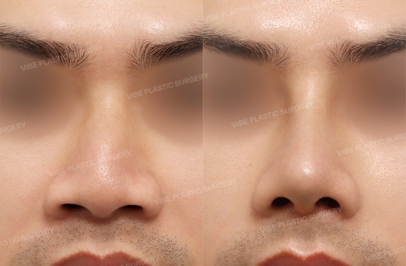 ศัลยกรรมจมูกผู้ชาย แค่ทำให้ดูเท่ขึ้นอย่างเดียวจริงหรือ? | ศัลยกรรมจมูกเพื่อการใช้งาน (Functional Rhinoplasty) แก้ไขผนังกั้นช่องจมูกคด โดย นพ. ยู ยองมุน VIBE Plastic Surgery สถานีชินนนฮยอน