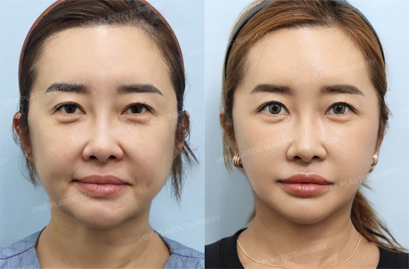 ดึงหน้าในวัย 40 เร็วเกินไปจริงหรือ? | หากมินิลิฟต์หรือร้อยไหมยังไม่ตอบโจทย์ โดย VIBE Plastic Surgery สถานีชินนนฮยอน