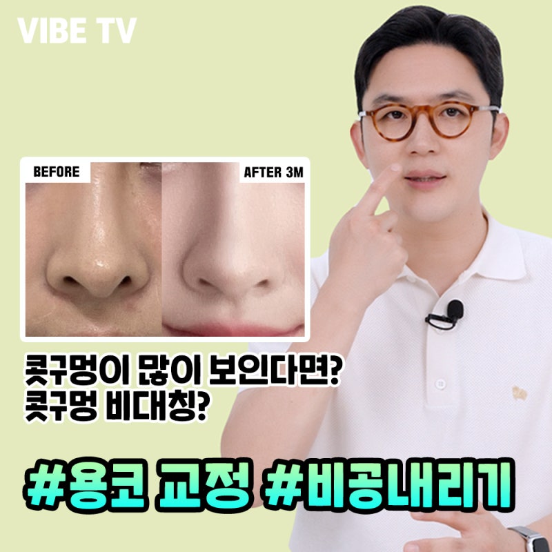 용처럼 콧구멍 많이 보이는 용코라면? 비공내리기수술로 교정!