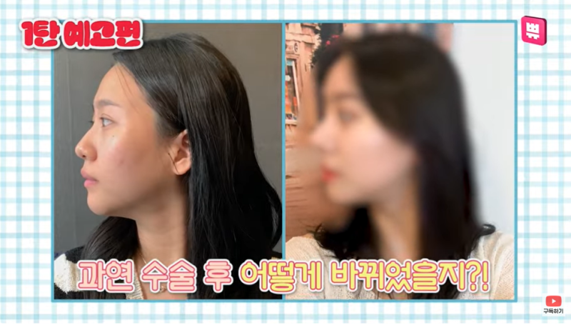 바이브에서 얼굴리모델링 후 싸-악 이미지변신한 마루님의 성형후기 1탄!