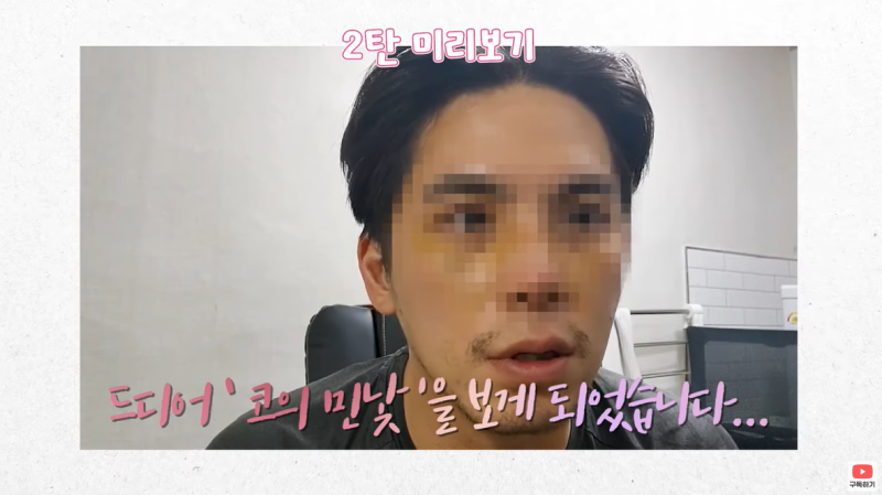 강남 남자 코성형 잘하는곳 바이브에서 눈, 코 수술한 건창님 리얼후기 2탄!