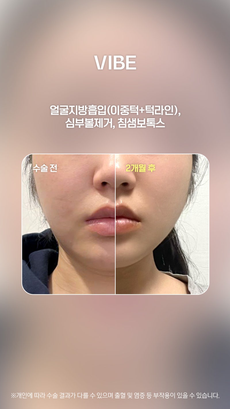 얼굴지방흡입으로 샤프한 얼굴라인 만들기