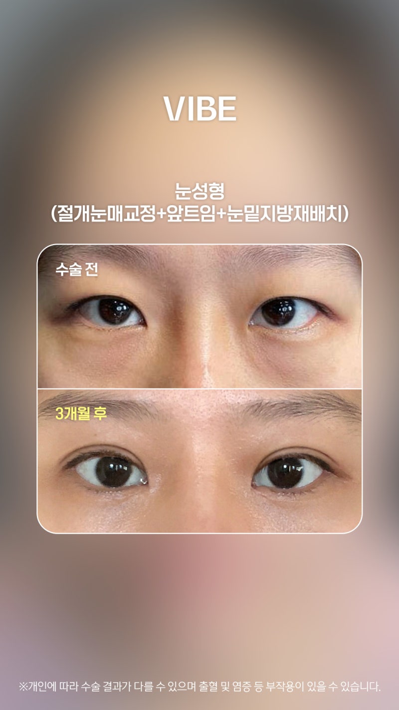 답답했던 속쌍, 꺼진 눈밑 개선으로 시원한 인상완성