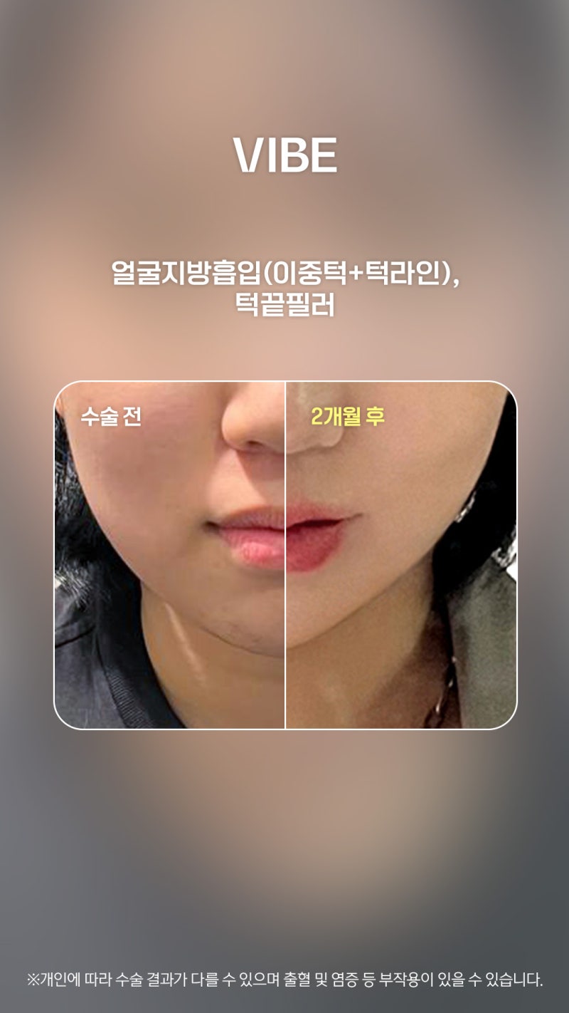 面部吸脂结合下巴玻尿酸填充,打造精致线条!