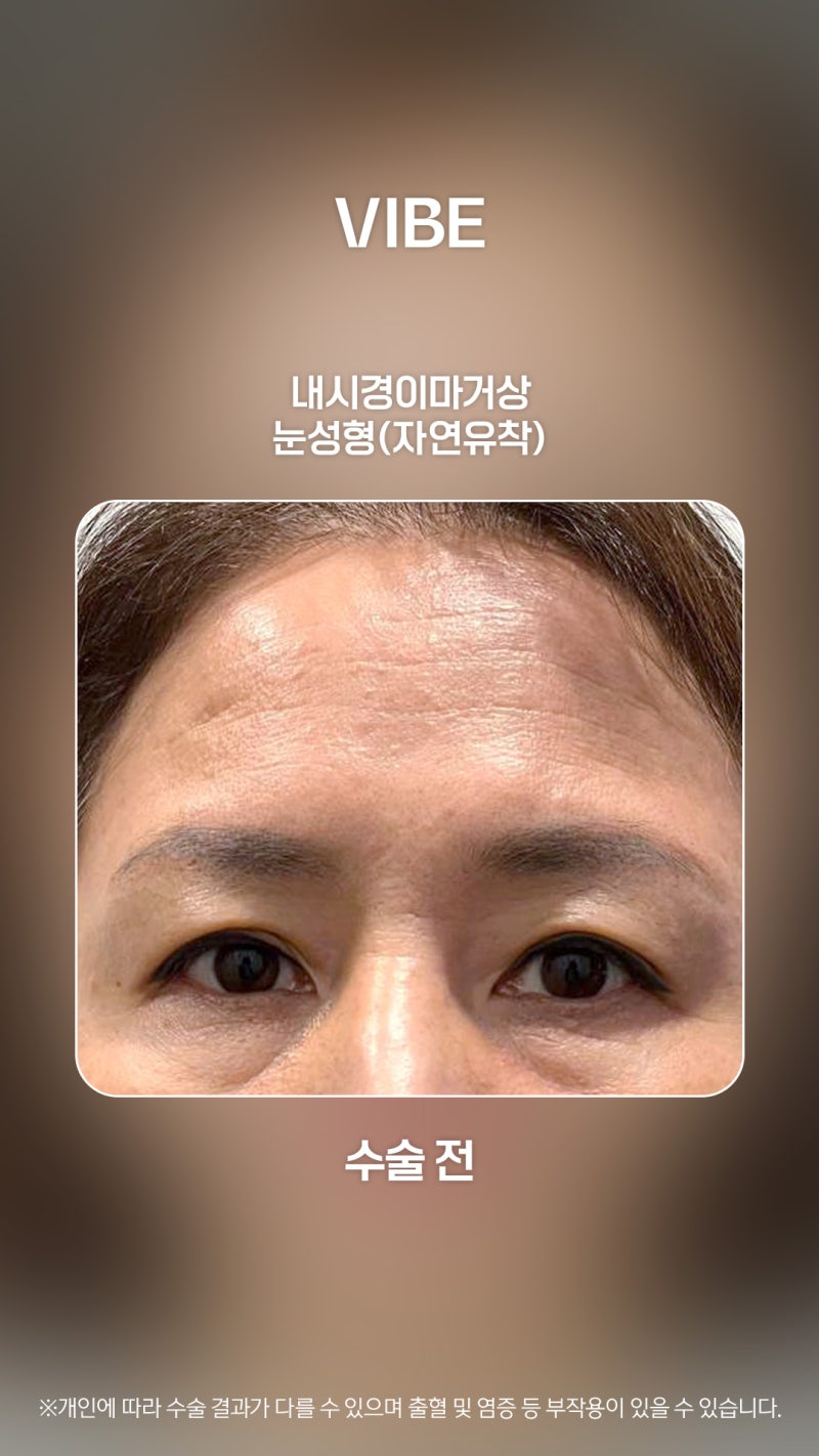 เปลี่ยนลุคให้ดูอ่อนเยาว์ด้วยการดึงหน้าผากผ่านกล้องและการทำตาสองชั้น!