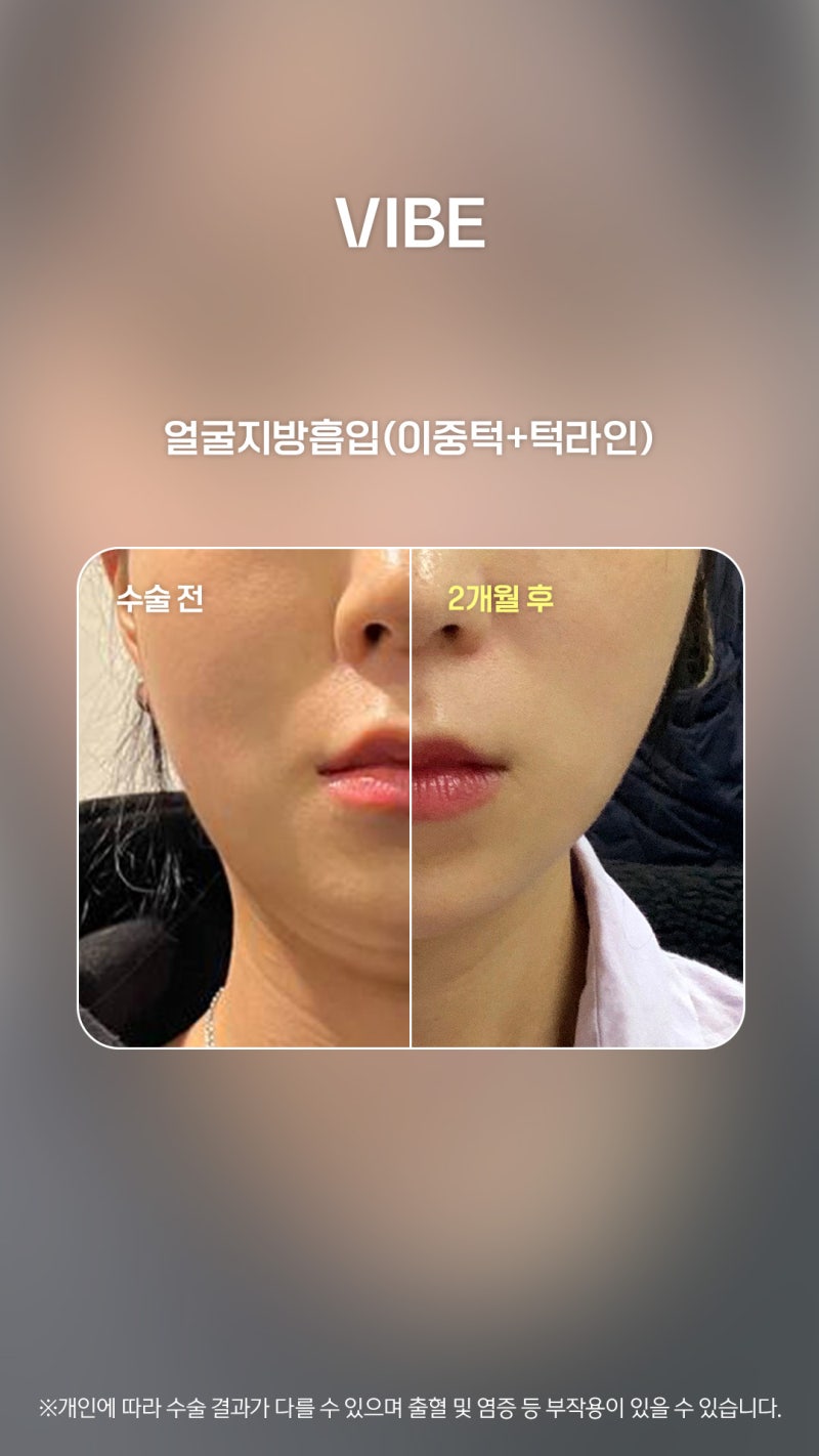 บอกลาคางสองชั้นด้วย LSSA การดูดไขมันแบบไม่ผ่าตัด