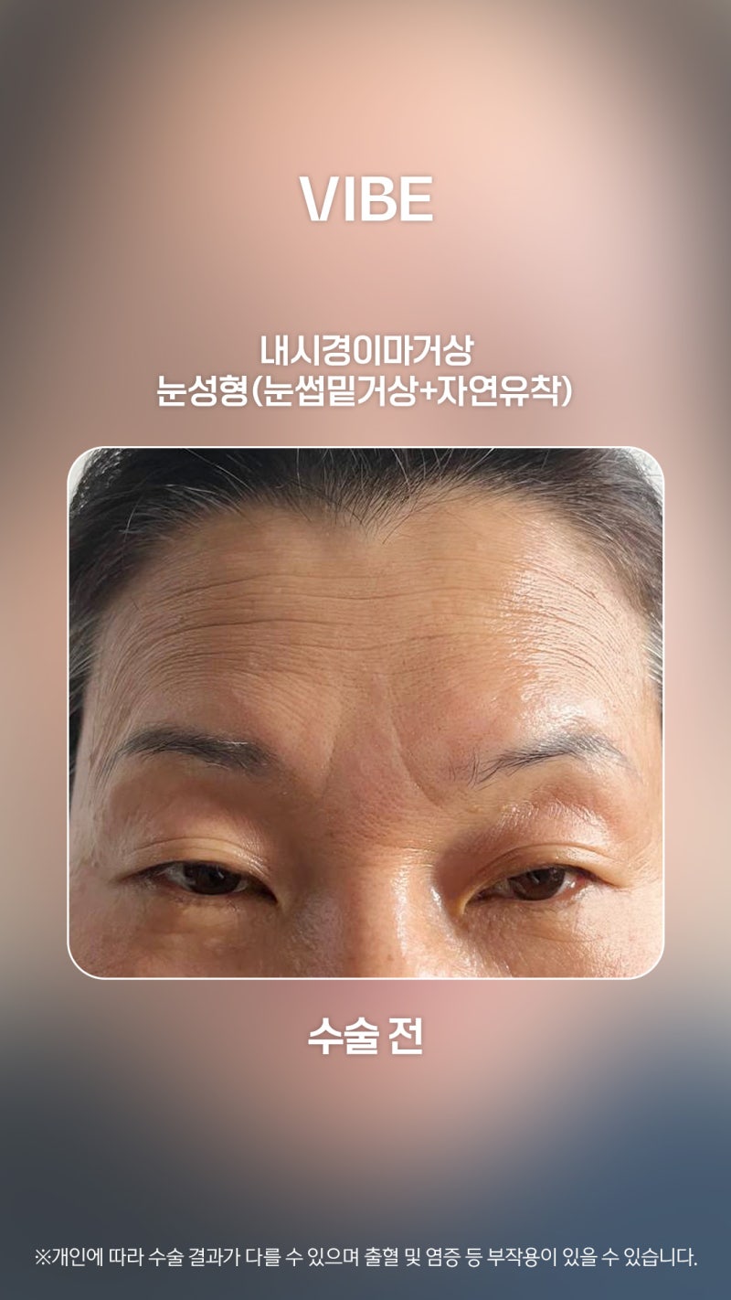 Gương mặt chảy xệ và chùng nhão, lấy lại vẻ đẹp thanh xuân nhờ phẫu thuật thẩm mỹ trung niên ✌