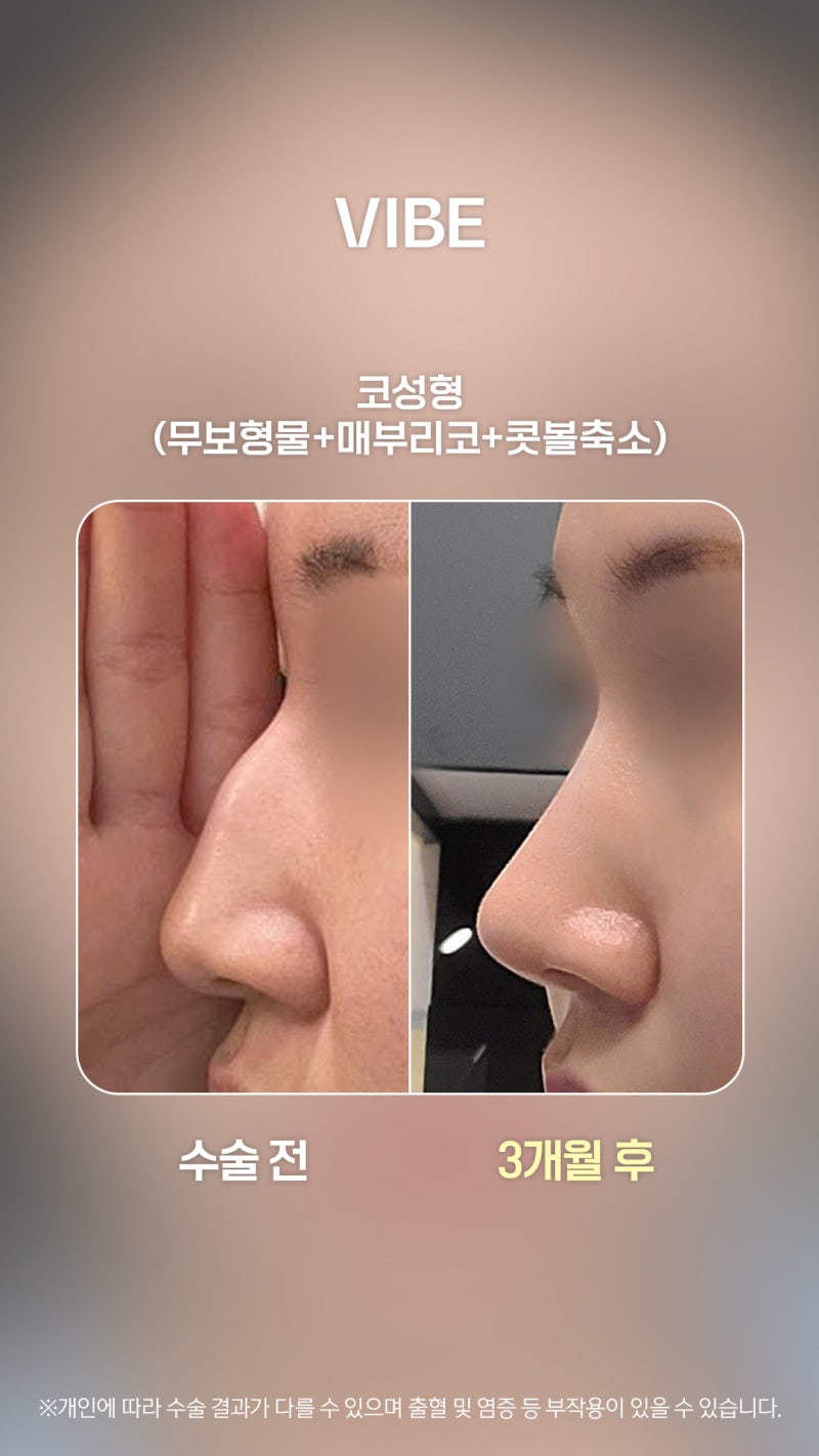 กังวลเรื่องจมูกฮัมพ์? จมูกเรียบเนียนได้ด้วยเทคนิค Dan-Yeon-Ko แบบไม่ใช้ซิลิโคน!