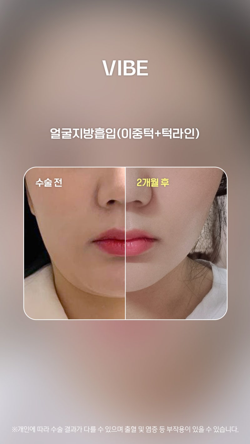 두툼 투턱, 엘싸(LSSA) 얼굴지방흡입으로 쏙쏙~