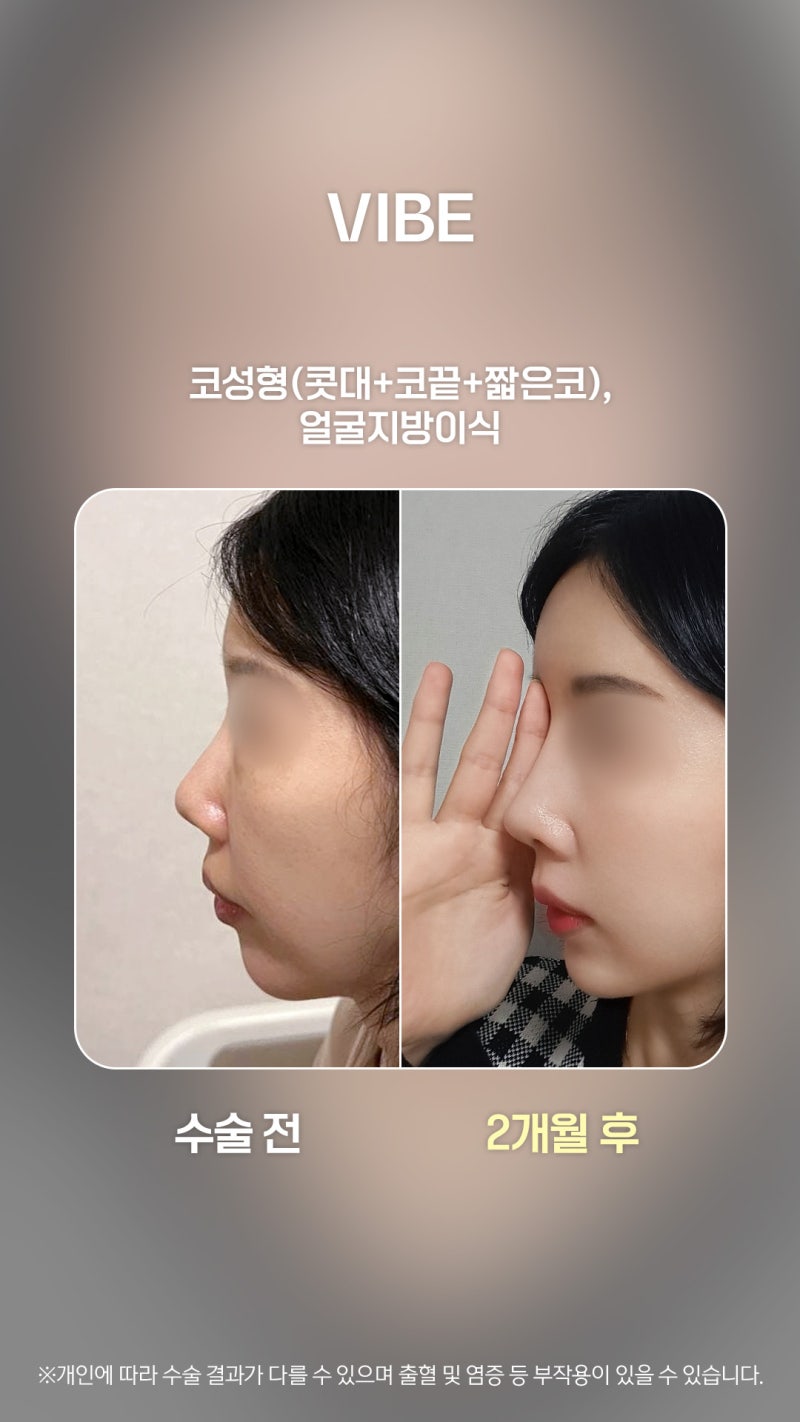 Achieving a Dimensional Face with Rhinoplasty and Full-Face Fat Grafting!
